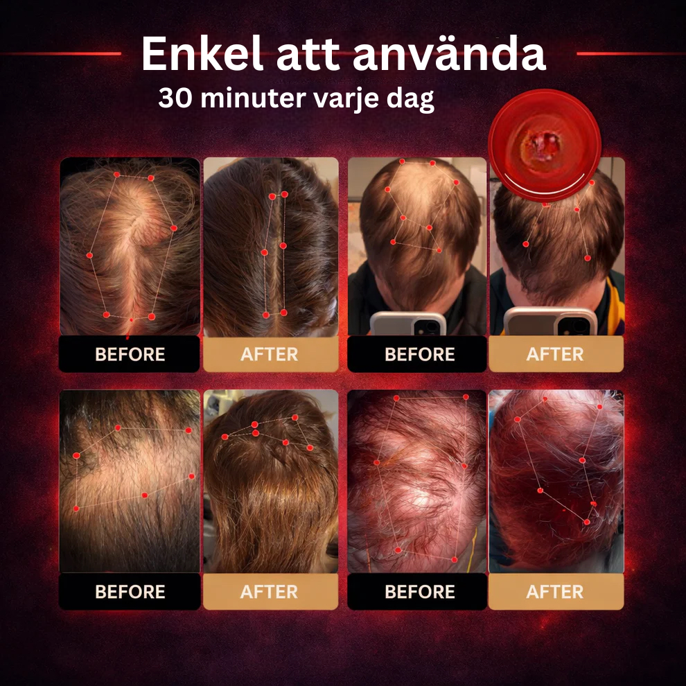 RedCap™ - Röd ljusterapi för återväxt